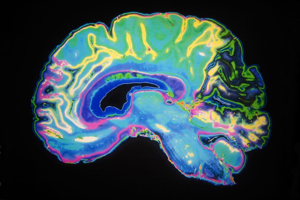 Coloured MRI Scan Of Human Brain