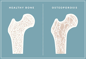 Preventing Osteoporosis